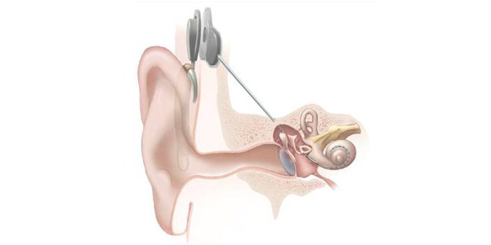 cochlear_implants.jpg